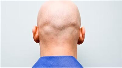 قريبًا... الرجل الأصلع سيتمكن من توليد الكهرباء من خلال صلعته!
