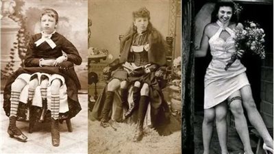 جوزيفين ميرتل ..المرأة ذات الأربع أرجل التى تزوجت وأنجبت 5 أبناء